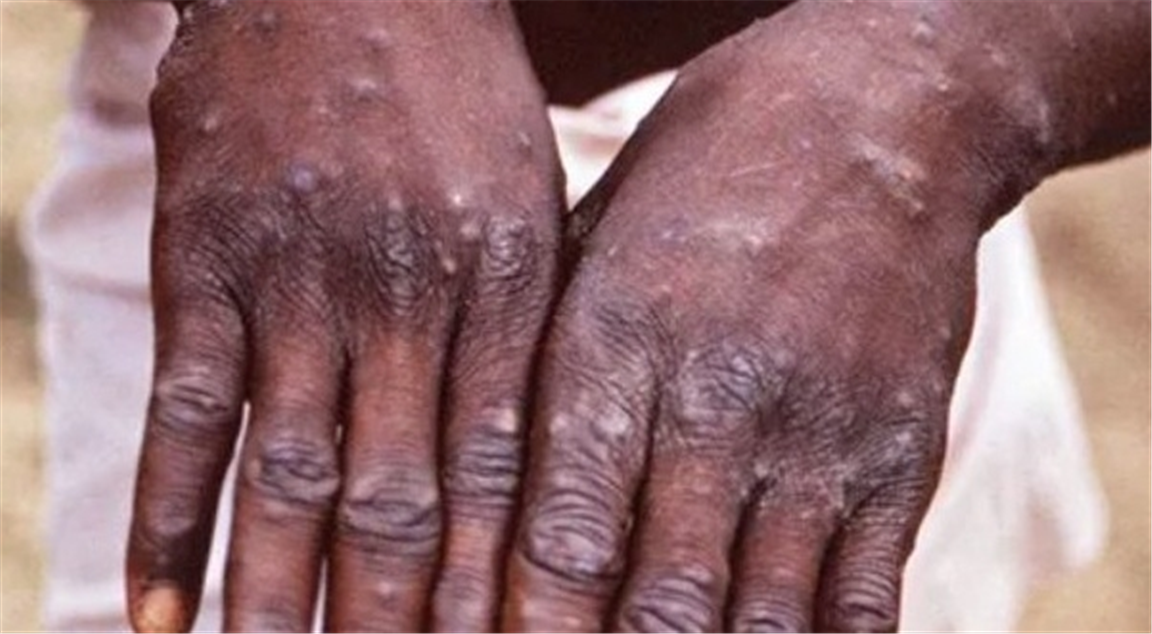 Monkeypox outbreak: India to screen arrival for virus signs, isolate sick patients; etails here