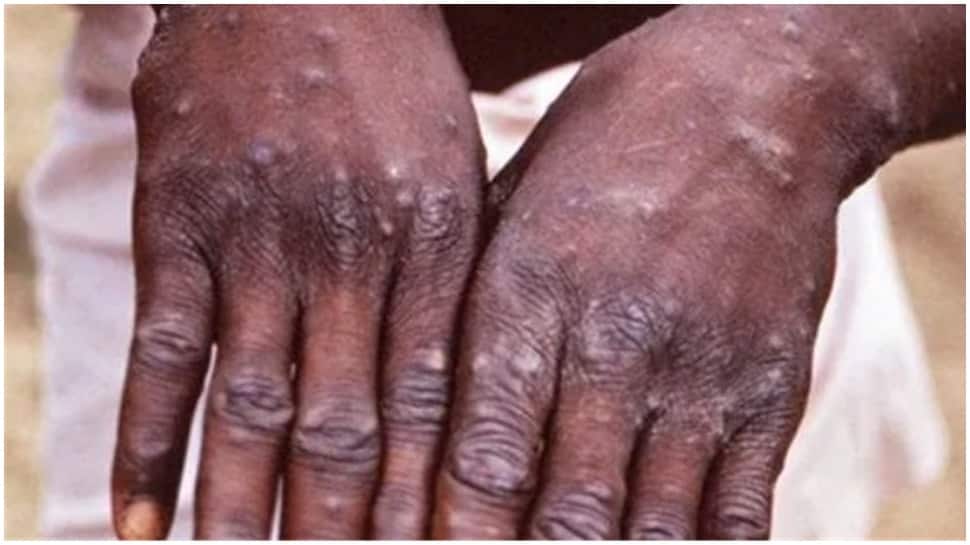 Kerala directs districts to remain vigilant as Monkeypox spreads to several parts of world