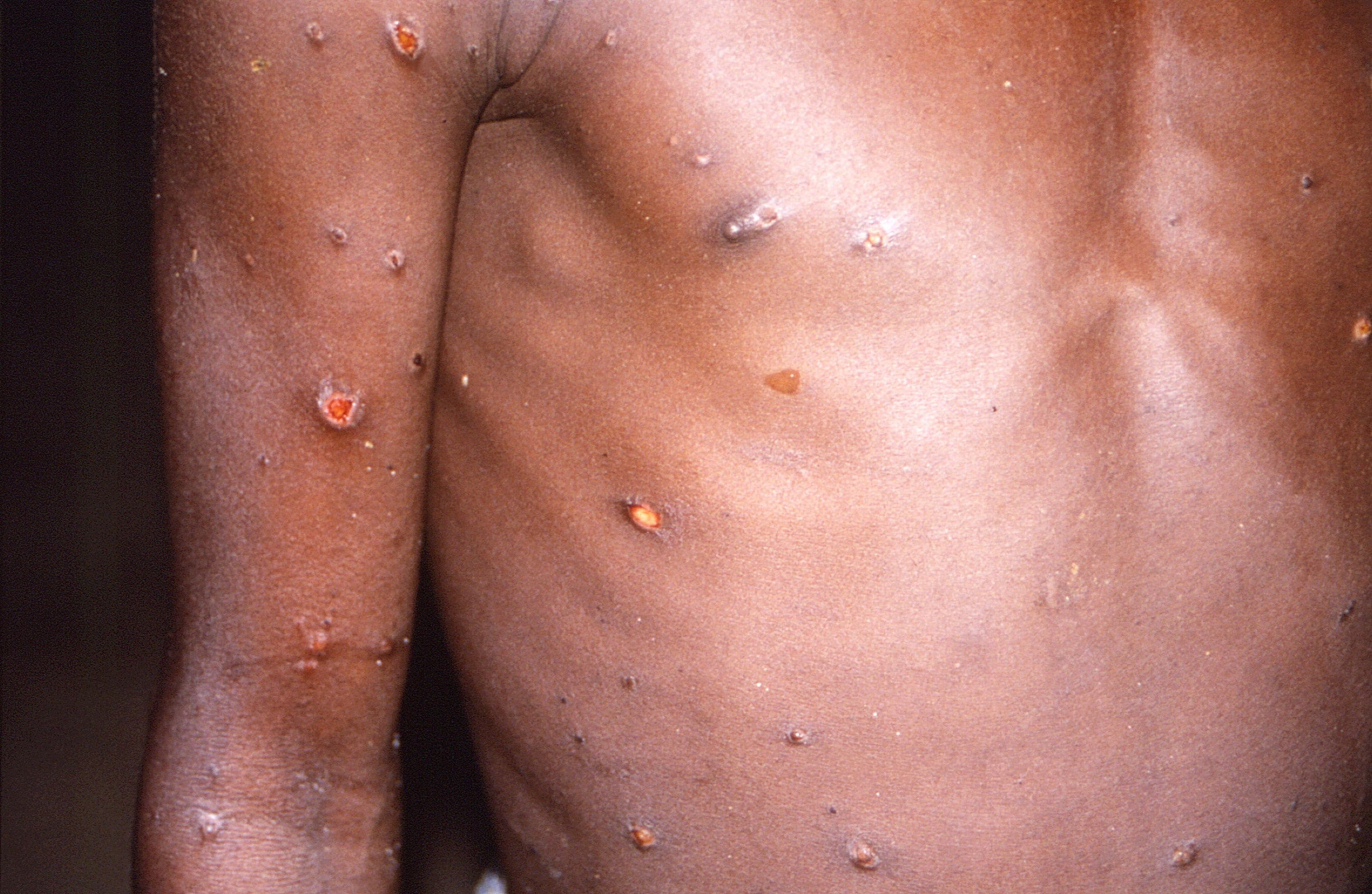 Monkeypox outbreak: WHO warns as disease spreads to 12 countries
