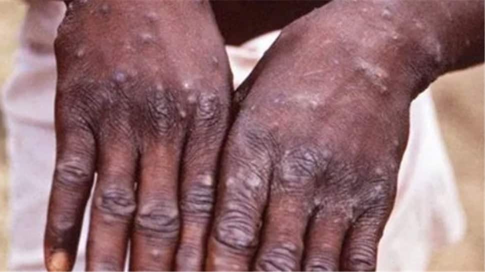 Monkeypox disease spreads to more countries, cases now reported in Israel, Switzerland and Austria