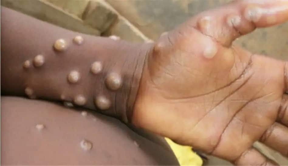 Monkeypox scare: Belgium becomes first country to introduce 21-day compulsory quarantine | World News - Vimarsana News
