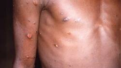 Monkeypox spread: Denmark and Scotland confirm first case