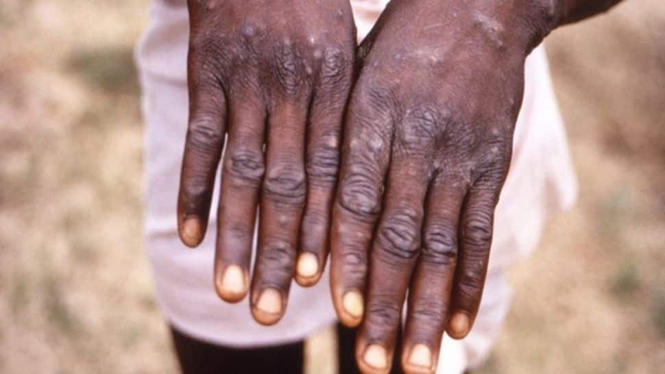 Is monkeypox as contagious as Covid-19? Expert says spread a 'matter of concern, but...'