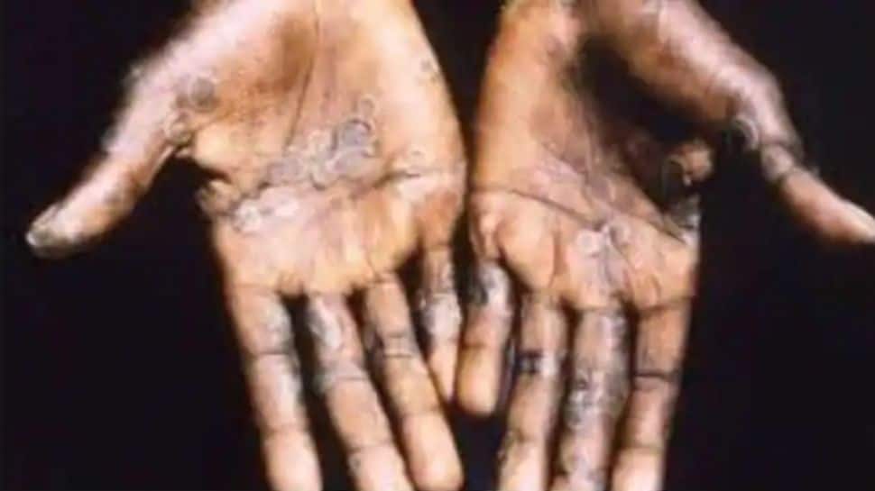 Monkeypox: WHO asks countries to increase surveillance as 200 cases confirmed in over 20 countries