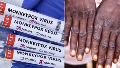 Monkeypox has now reached at least 20 nations