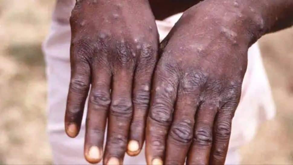 Monkeypox outbreak: India is prepared, no cases in country yet, says ICMR