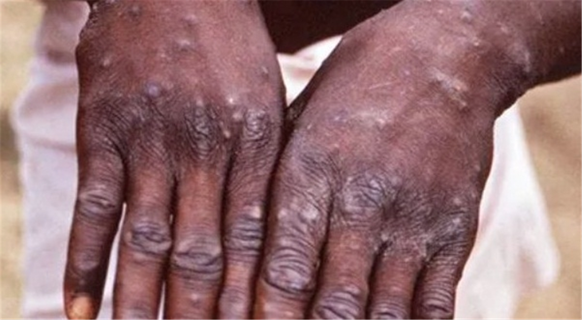 Monkeypox: Symptoms