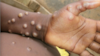 What is Monkeypox virus?