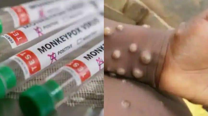 Monkeypox alert: India`s Health Ministry issues guidelines after 550 confirmed cases found in 30 non-endemic countries 