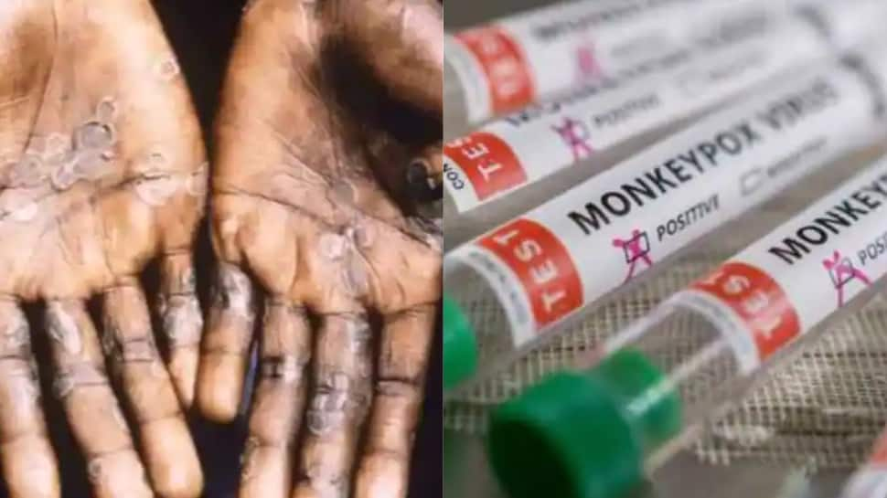 Monkeypox outbreak: 780 cases confirmed in over 27 countries