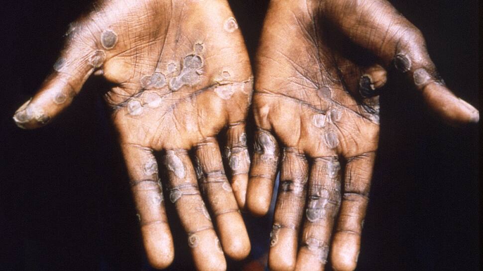 What is monkeypox virus?