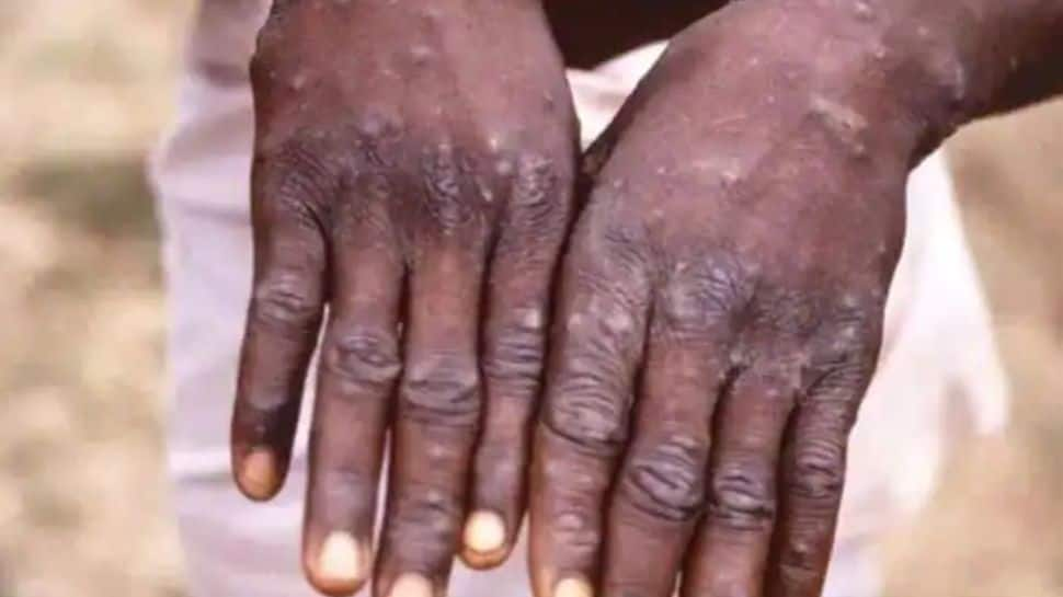 No cases of monkeypox infections in India yet