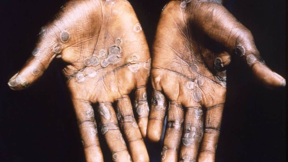 What is Monkeypox? 