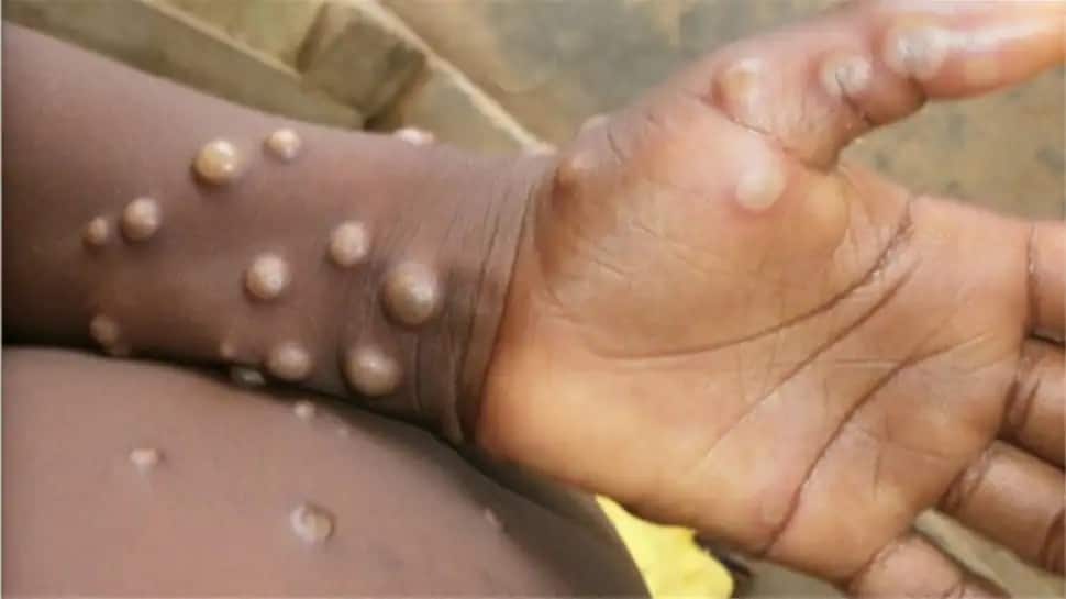 Un patient infecté par le virus Monkeypox s’enfuit de l’hôpital, CE lieu en alerte maximale |  Nouvelles du monde