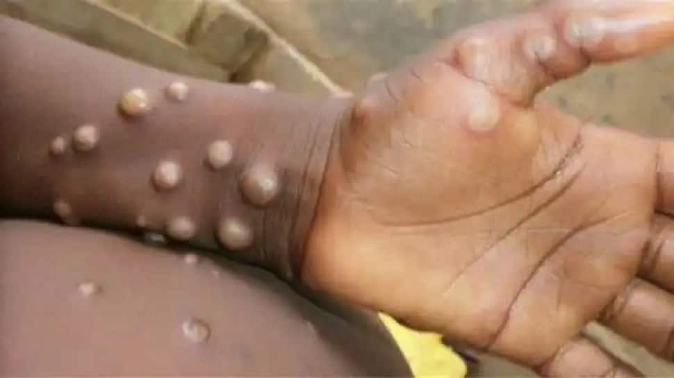 Monkeypox cases in Britain surpass 500