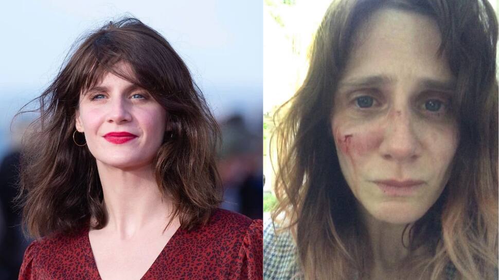 French actor Judith Chemla shares disturbing photos of &#039;injuries&#039; stemming from domestic abuse