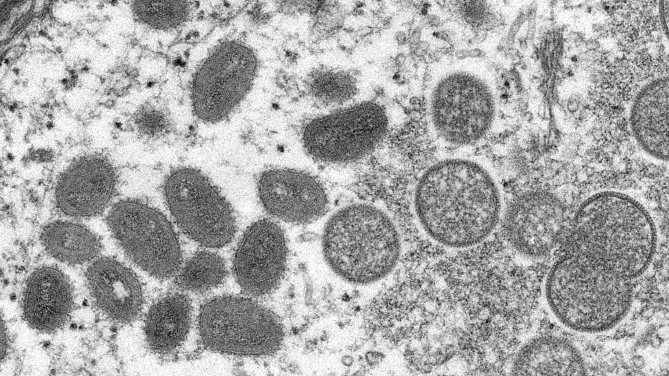 Monkeypox virus: Russia reports its first case, patient recently returned from Europe