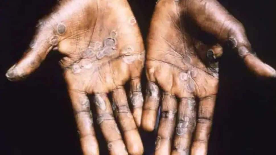 Monkeypox in India: Co-passengers of infected Kerala man being monitored; Know what are symptoms to watch out for