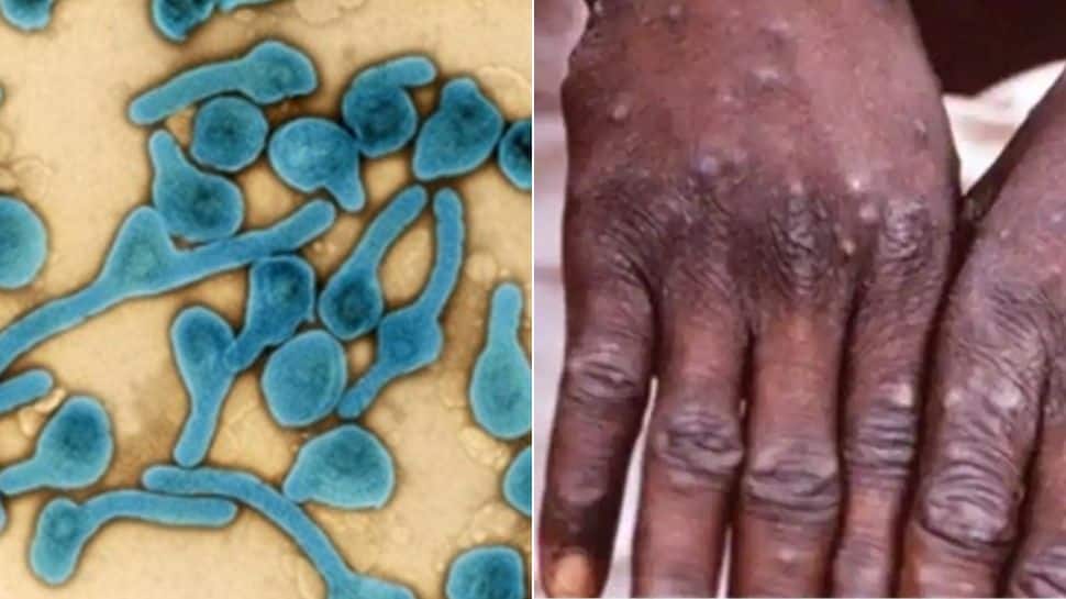 Monkeypox vs Marburg virus: Which one is more DEADLY? Which spreads faster? - Details here