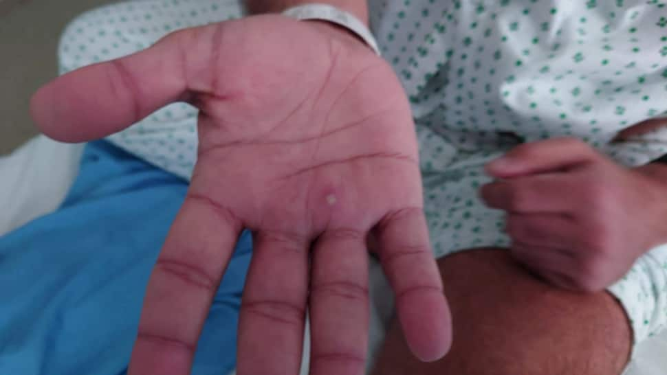 Monkeypox virus reaches Delhi, India&#039;s fourth case confirmed in a 34-year-old man - Details here