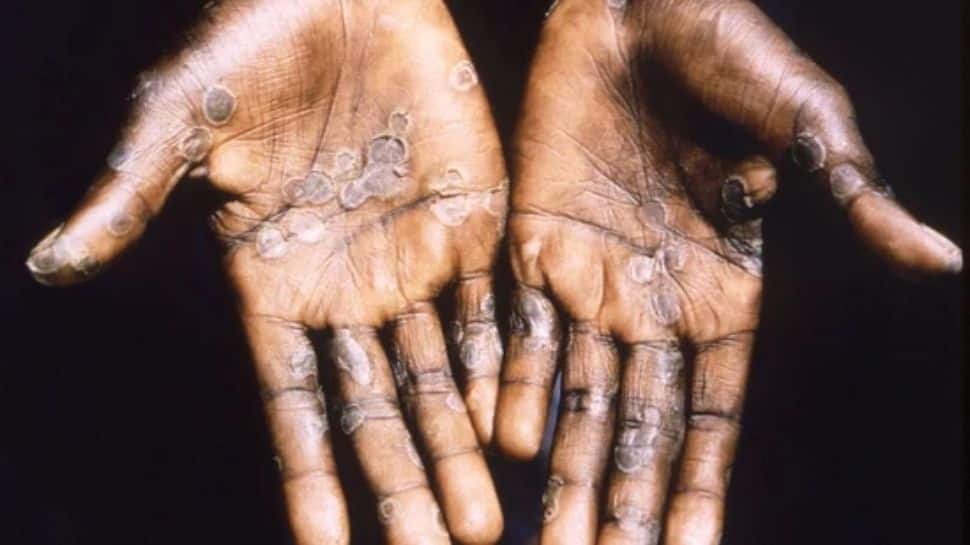 Monkeypox in India: Is it an STD? Read all about monkeypox symptoms, prevention as country logs 4th case