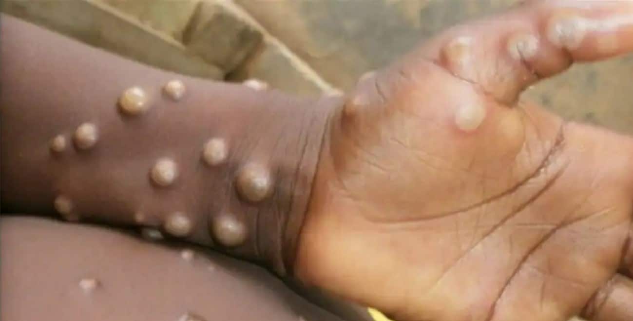 Monkeypox strain in India different from Europe: ICMR