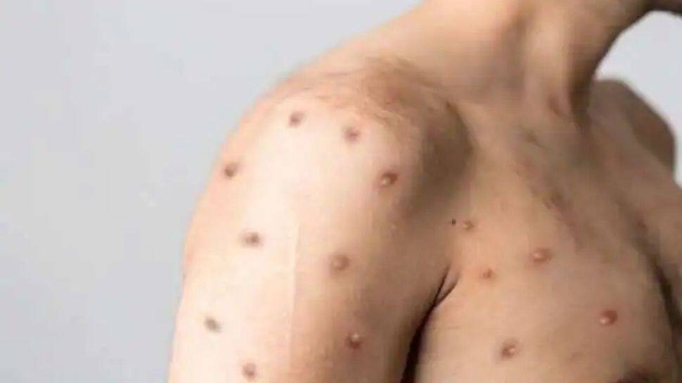 Monkeypox in India: Suspected case in Himachal; Delhi patient had visited state for 'stag party' Monkeypox in India: Suspected case in Himachal; Delhi patient had visited state for 'stag party'