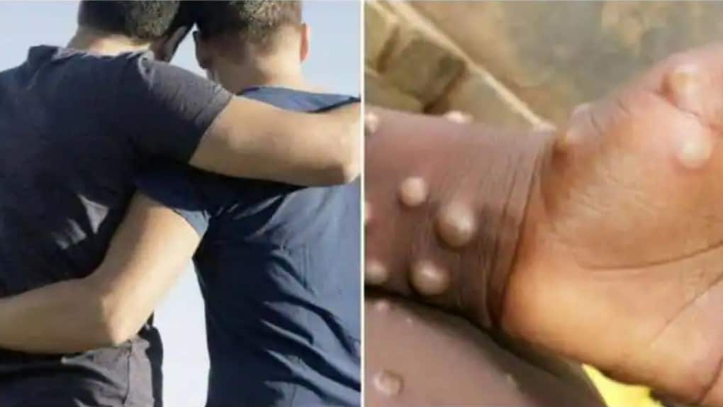 Explained: Link between Monkeypox, LGBTQs and Sex - MUST READ - Vimarsana News