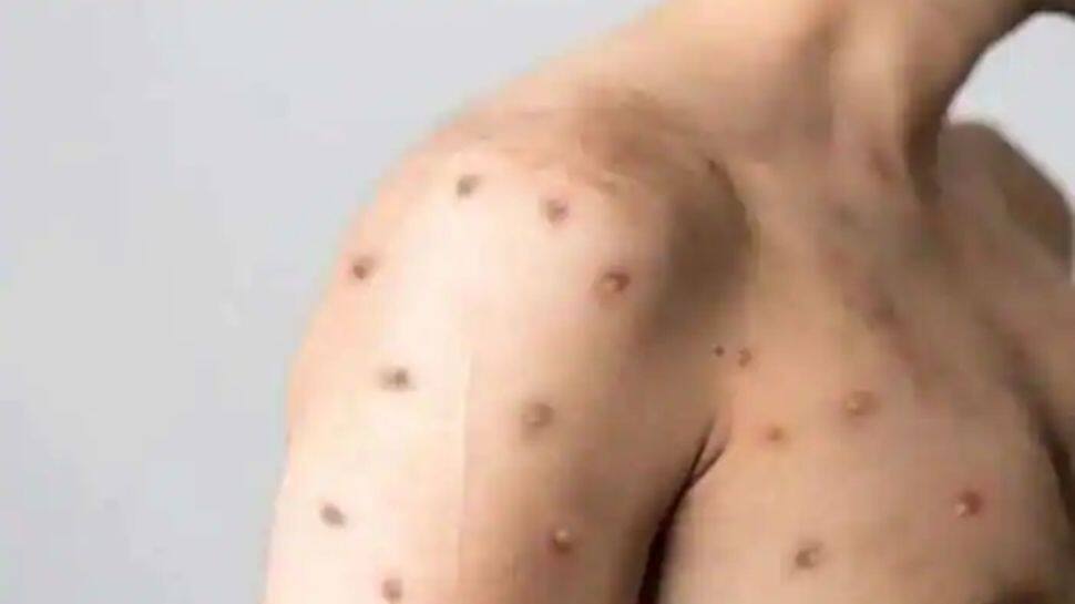 Delhi records 5th Monkeypox case as 22-year-old woman tests positive