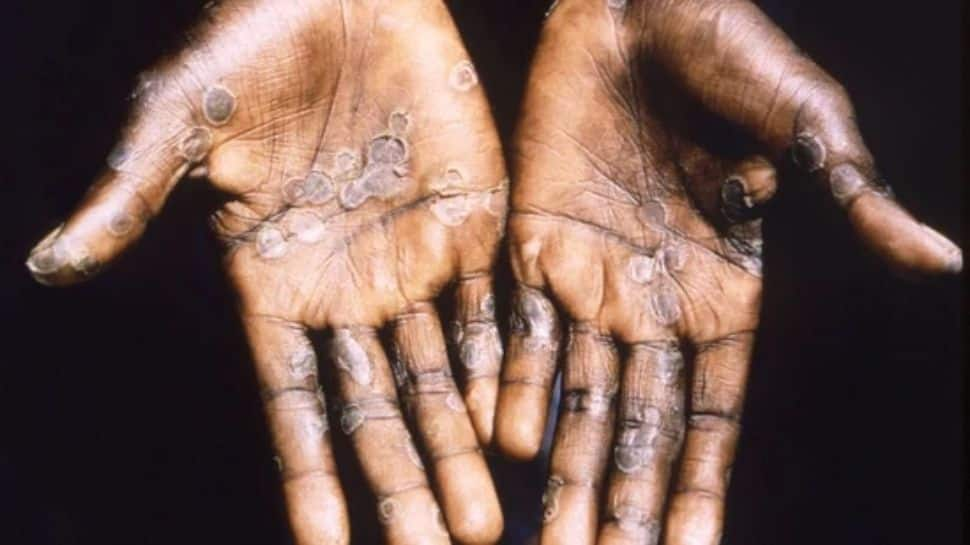 Dans une première, un homme est testé positif au monkeypox, au Covid19 et au VIH en même temps – Détails ici |  Nouvelles du monde