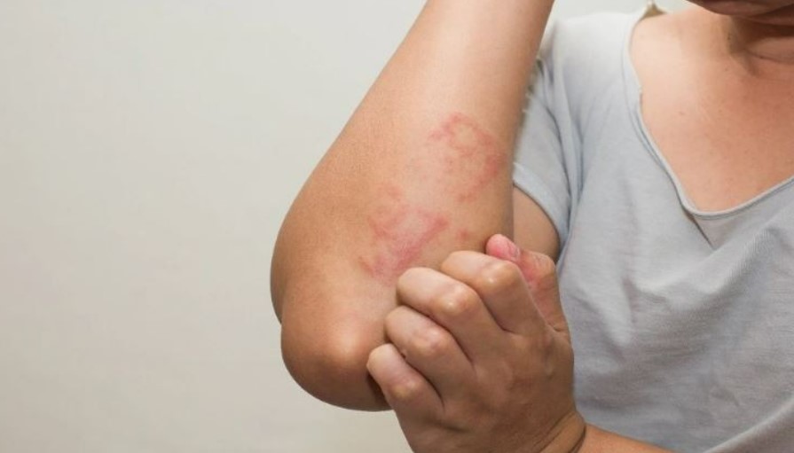 How to safeguard yourself from allergic diseases? Expert Dr Prashant Jerath explains How to safeguard yourself from allergic diseases? Expert Dr Prashant Jerath explains