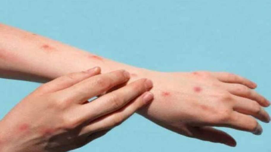 China reports its first monkeypox case as several provinces struggle to ...