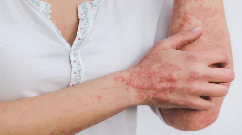 Psoriasis is not an independent risk factor for heart attacks in terminally ill patients, the study says.health news