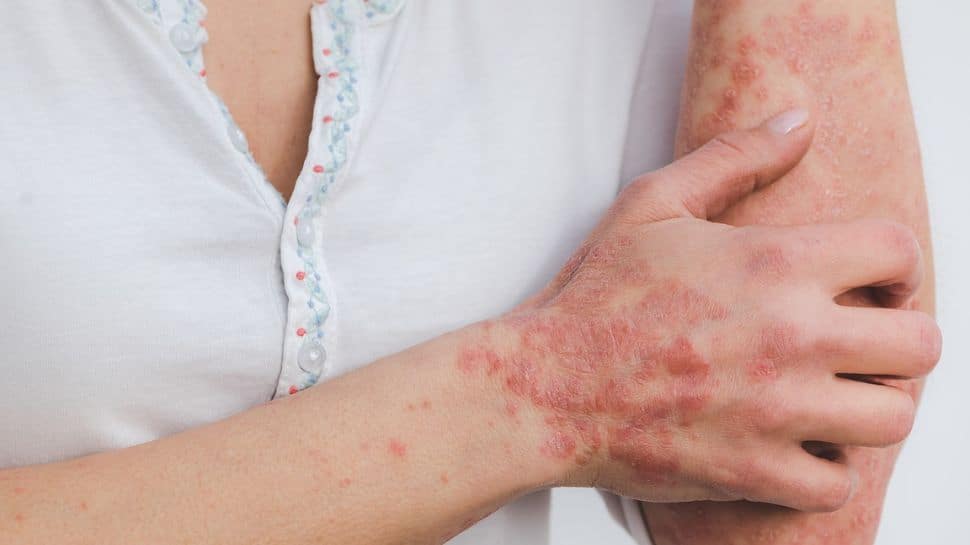 EXCLUSIVE: World Psoriasis Day 2022 – How do you get Psoriasis? All want to know about skin condition, risk factors, treatment