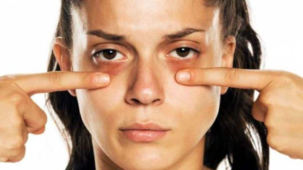 Skincare 101: 5 Home remedies to remove dark circles naturally