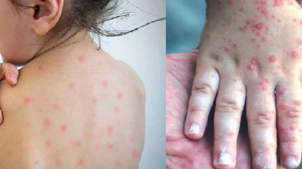 Measles outbreak wreaks havoc in Mumbai, 16 dead, over 500 cases in three months