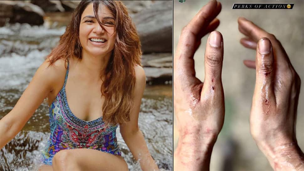 Samantha Ruth Prabhu Injured On Sets Of Citadel, Shares Pic Of Bruised Hands