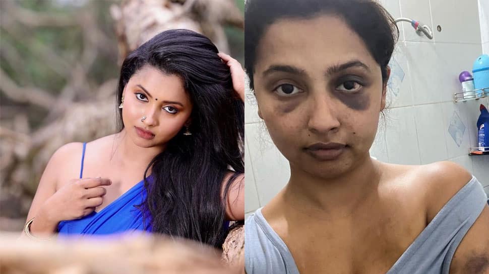 Malayalam Actress Anicka Vikhraman Shares Horrifying Pics of Bruise Marks, Accuses Ex-BF Of Assault