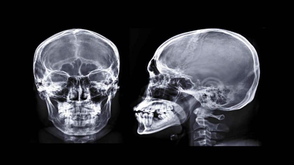 Men Are More Likely Than Women To Suffer From A Skull Fracture: Study