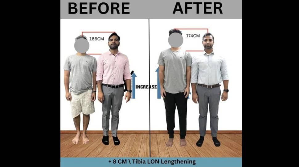 Limb Lengthening made easy – Height Increase Info provides an effective way to add a few more inches to your height