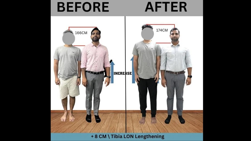 Limb Lengthening made easy – Height Increase Info provides an effective way to add a few more inches to your height Limb Lengthening made easy – Height Increase Info provides an effective way to add a few more inches to your height