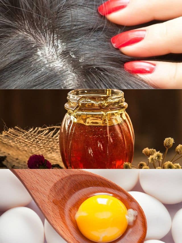 Home remedies for dry deals itchy scalp