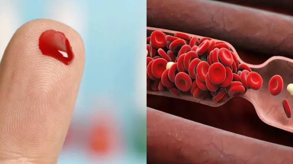 Blood Clots: Walking A Mile Daily Can Stop Blood Clotting, Says Doctors
