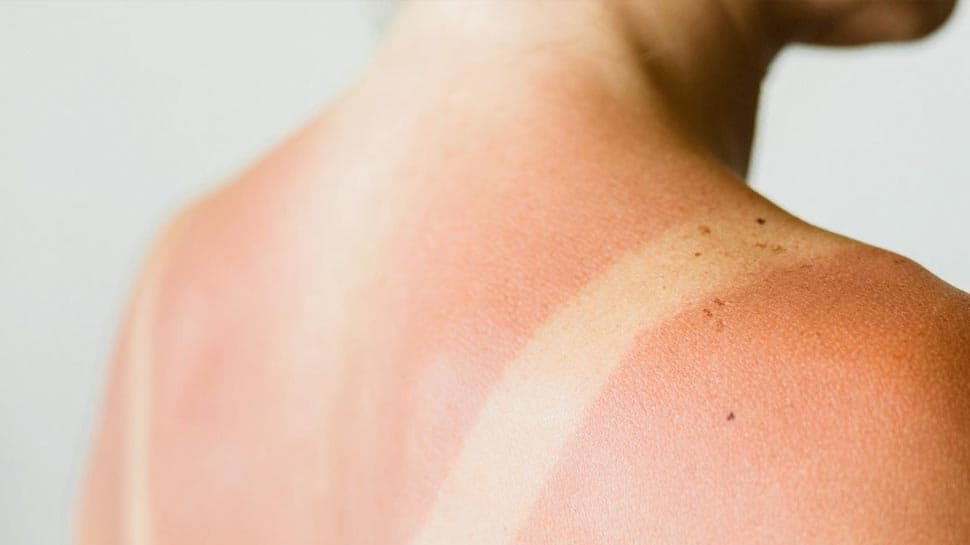 Sunburns Got You Down? Here Are 5 Simple And Effective Home Remedies For Summer Protection