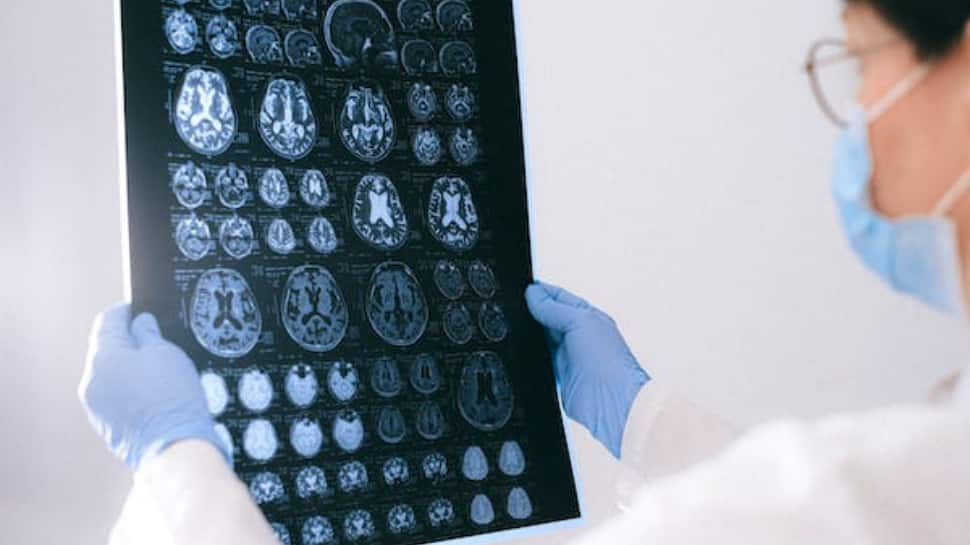 World Brain Tumor Day 2023: Early Detection Is Key To Better Prognosis, Say Experts