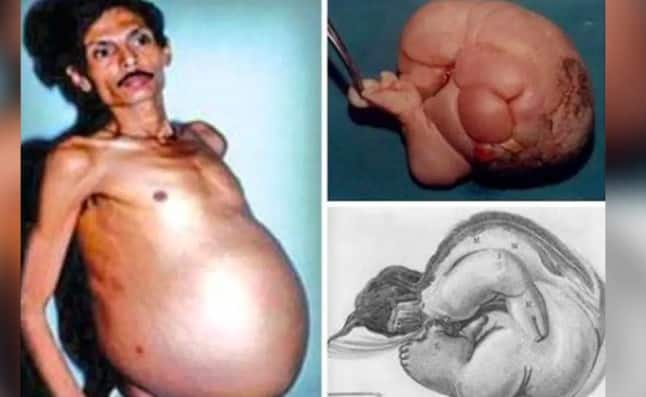 Rare! This Nagpur Man Was &#039;Pregnant&#039; For 36-Years With Twins - Know Surprising Story