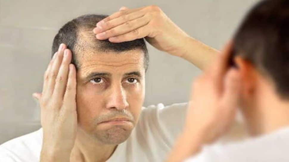 Thinning Hair Troubles? Expert Explains Do’s And Don&#039;ts To Follow For Hair Growth 