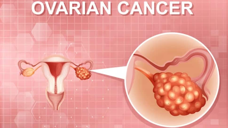 Why Hairdressers, Beauticians, Accountants Are At High Risk Of Ovarian Cancer? Study Reveals