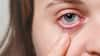 Conjunctivitis Guidelines   