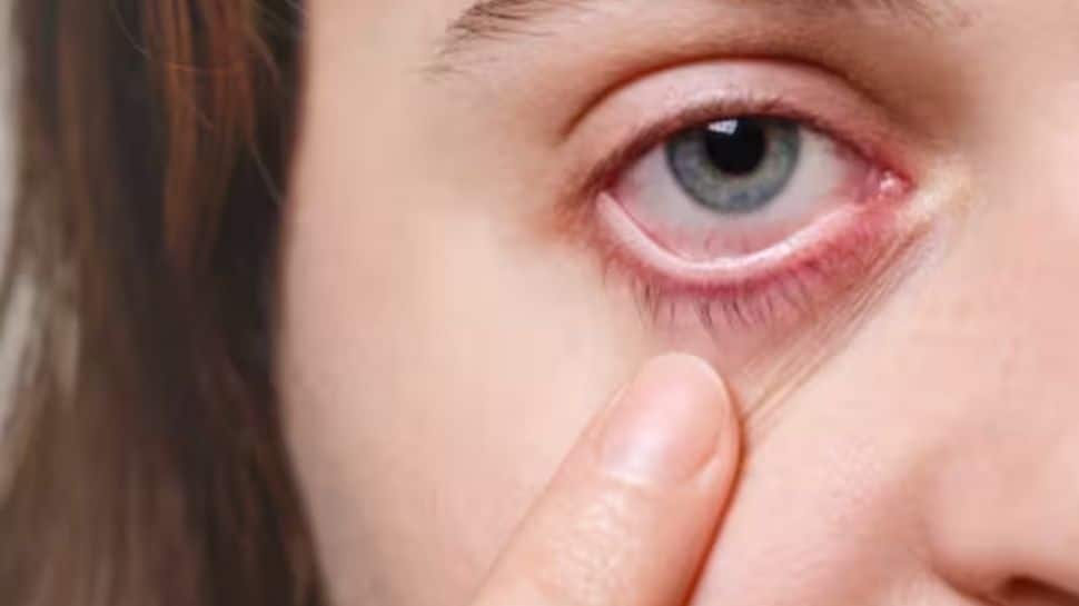 Conjunctivitis Eye Care Tips: Expert Shares Risks, Types And Prevention